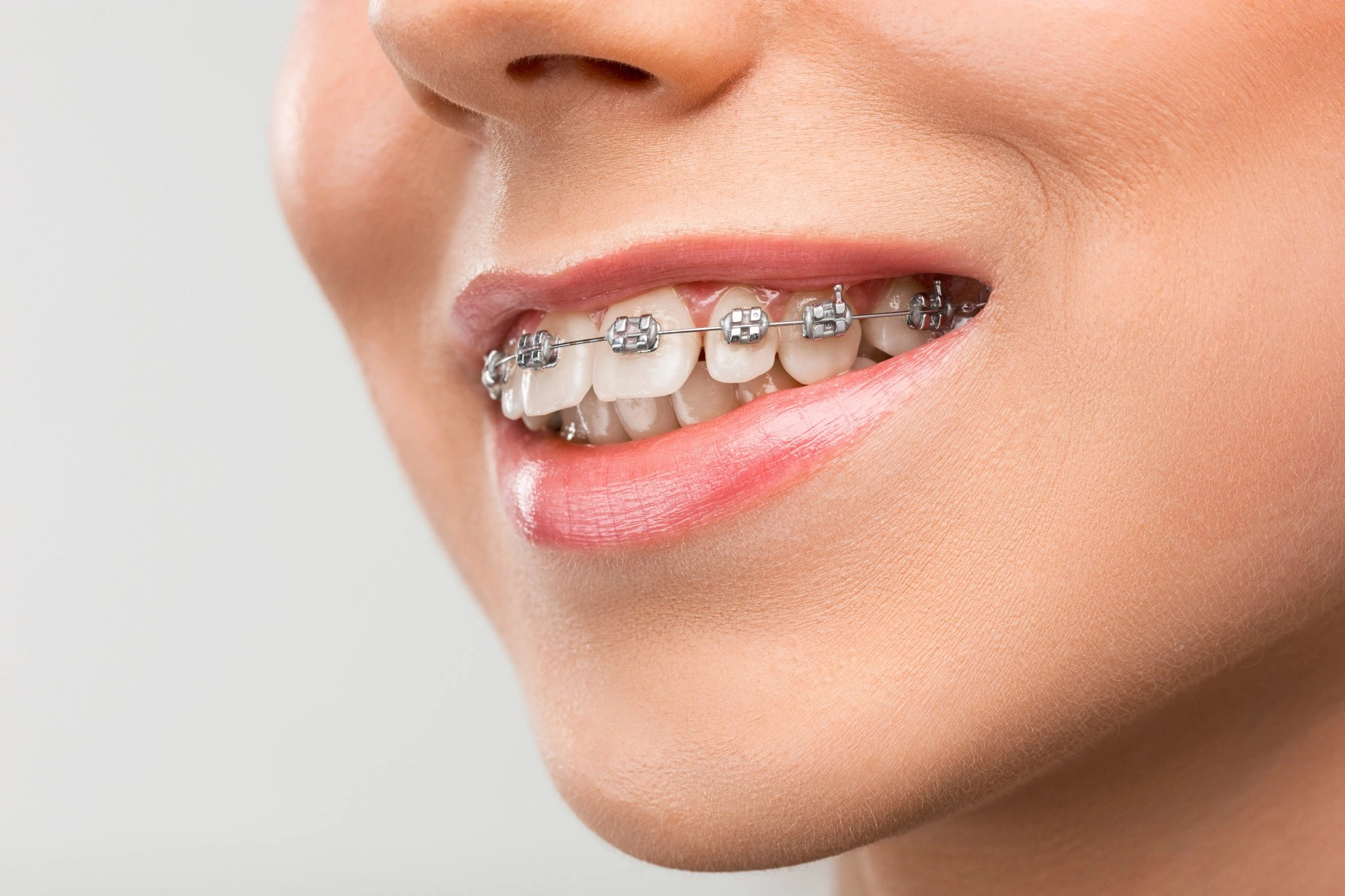 Names for Braces