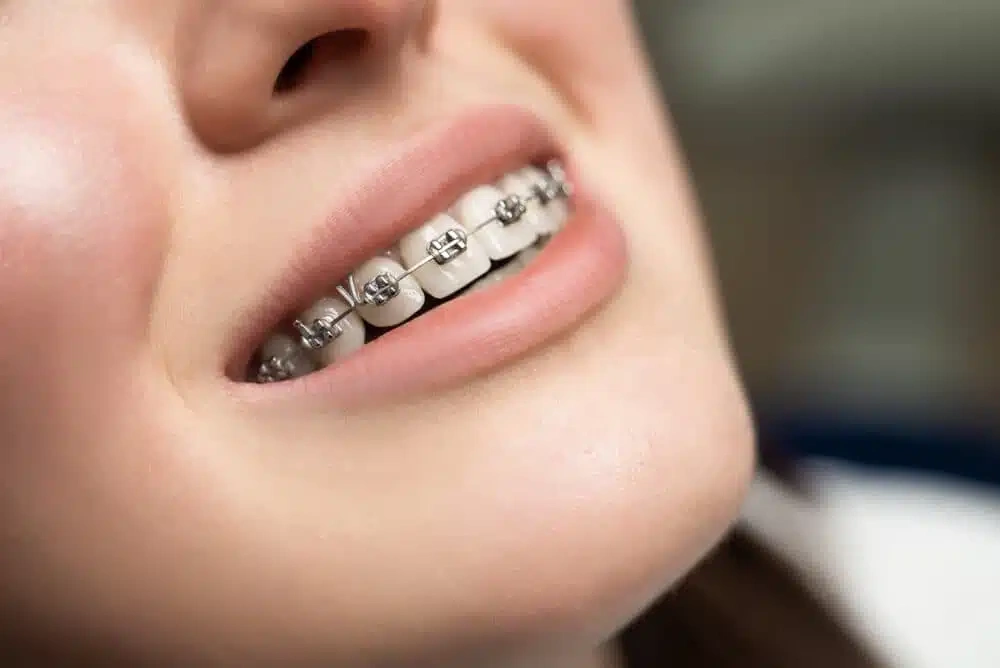 Names for Braces